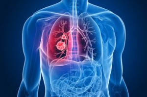 lung cancer