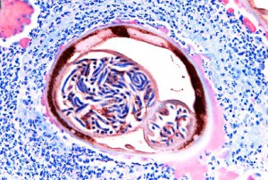 river blindness