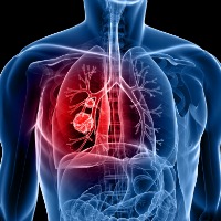 Lung Cancer2