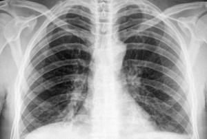 Tuberculosis