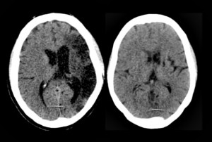 Scans of Post-Ebola Syndrome affected brains