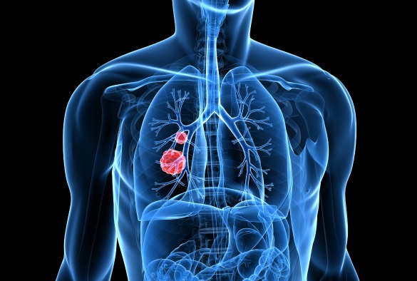 Lung cancer 1