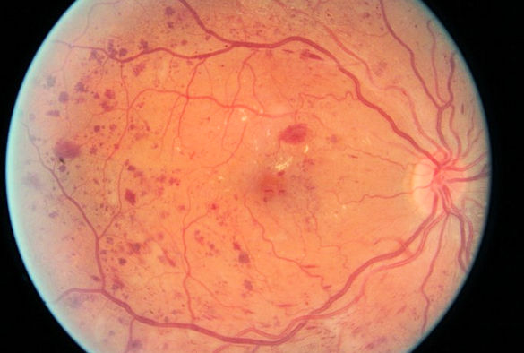 Image result for diabetic eye