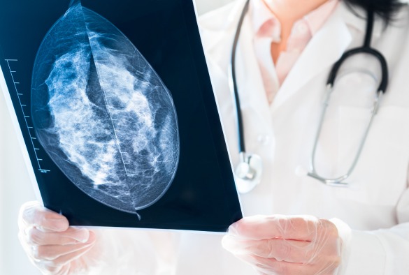 新的乳腺癌 ER+ 疗法显示出临床益处：研究