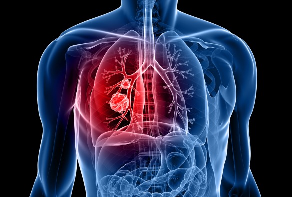 Illustration to show lung cancer