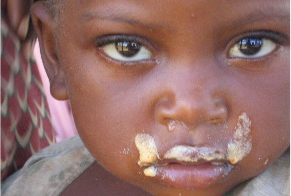 Long-term outcomes after severe childhood malnutrition in adolescents in Malawi - close up of study participant's face